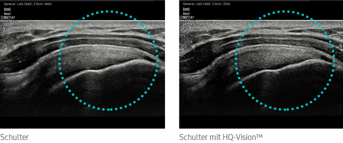 Schulter, Schulter mit HQ-Vision™