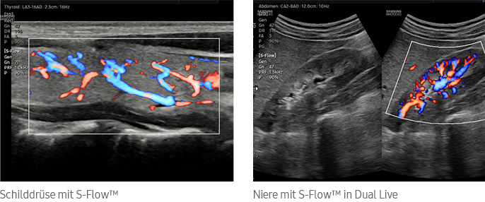 Schilddrüse mit S-Flow™, Niere mit S-Flow™ in Dual Live