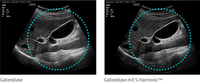 Gall bladder with S-HarmonicTM
