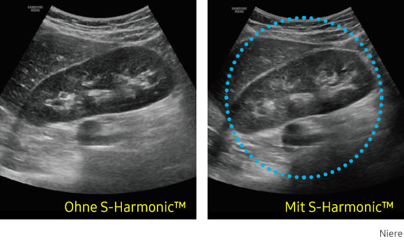 Ultraschallbild Niere links ohne S-Harmonic und rechts mit S-Harmonic.