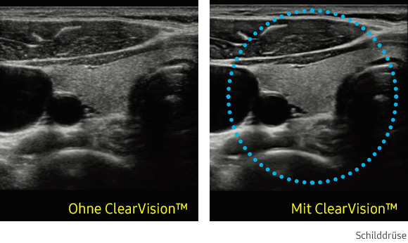 Ultraschallbild Schilddrüse links ohne ClearVision und rechts mit ClearVision von Samsung.