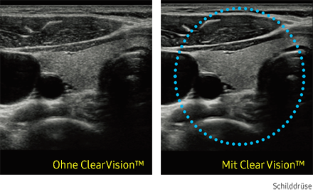 Ultraschallbild Schilddrüse links ohne ClearVision und rechts mit ClearVision von Samsung.
