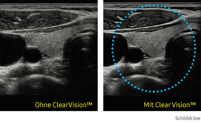 Ultraschallbild Schilddrüse links ohne ClearVision und rechts mit ClearVision von Samsung.
