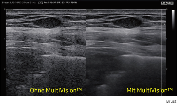 Ultraschallbild Brust links ohne MultiVision und rechts mit MultiVision von Samsung.