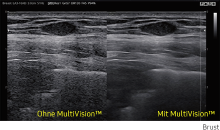 Ultraschallbild Brust links ohne MultiVision und rechts mit MultiVision von Samsung.