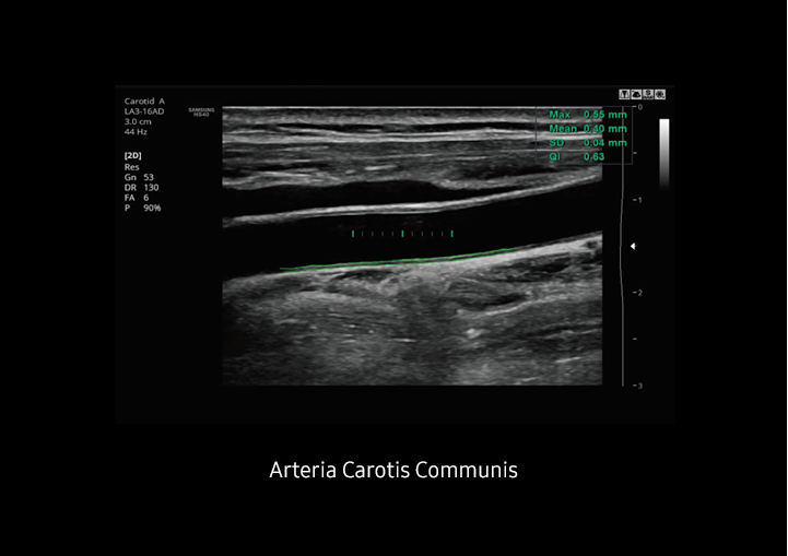Ultraschallbild CCA mit Auto IMT