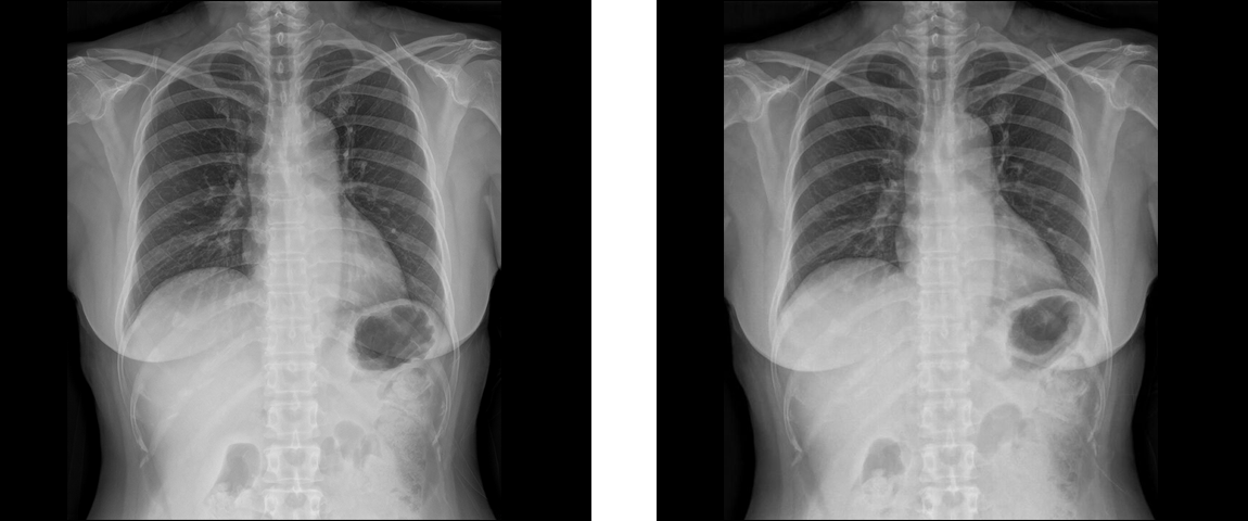 Thorax PA  (120 kVp / 1.68 mAs / 16.7 μSv / BMI 25.6) Thorax PA (120 kVp / 0.82 mAs / 8.05 μSv / BMI 25.6)
