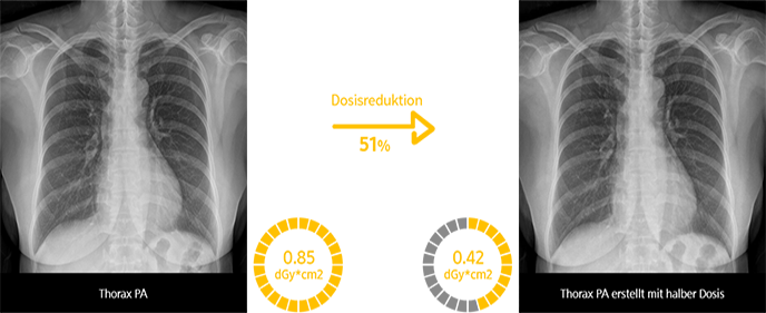 Links: Thorax PA Rechts: Thorax PA erstellt mit halber Dosis