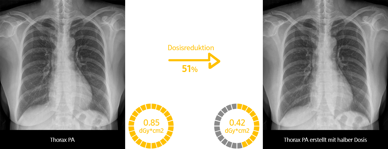 Links: Thorax PA Rechts: Thorax PA erstellt mit halber Dosis