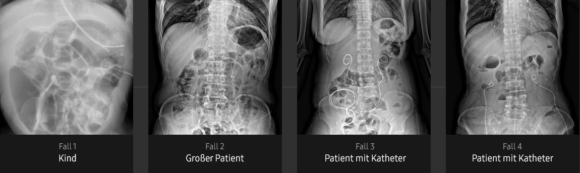 Röntgenbilder von Abdomen (Kind, großer Patient, Patient mit Katheter) aufgenommen mit digitalem Röntgengerät von Samsung