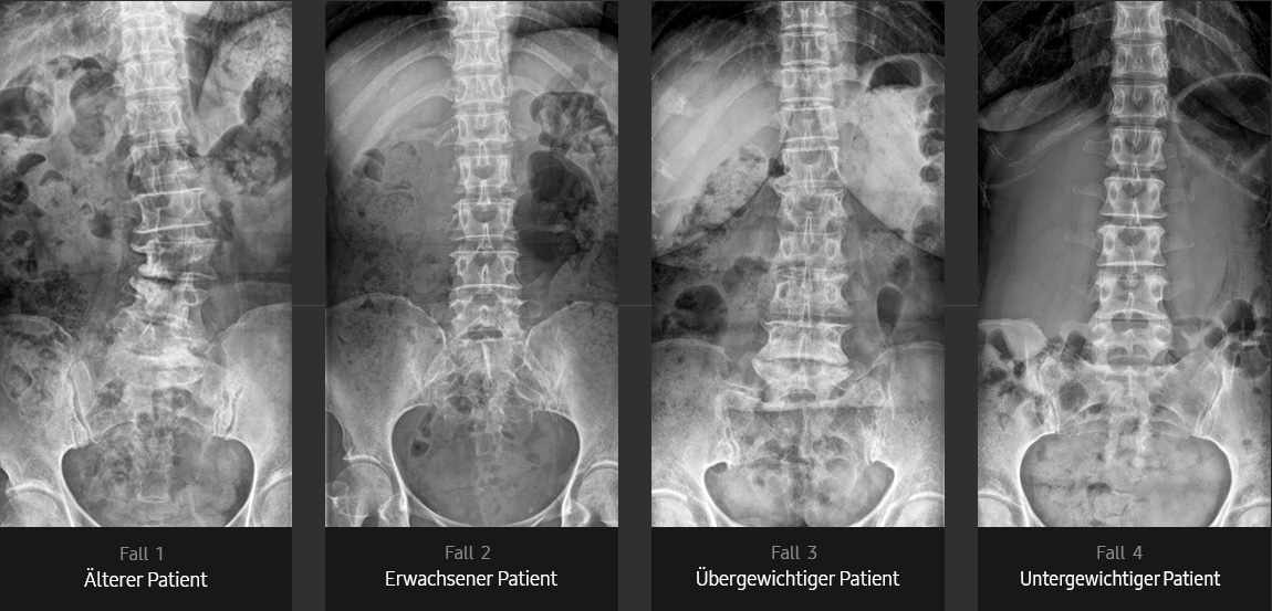 Röntgenbilder von Lendenwirbelsäule AP (älterer Patient, erwachsener Patient, übergewichtiger Patient, dünner Patient) aufgenommen mit digitalem Röntgengerät von Samsung