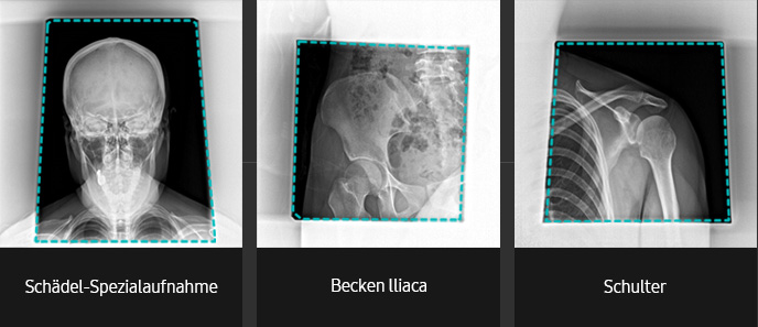 Automatischer Shutter (Ansicht Schädel Town, Ansicht Becken Iliaca, Ansicht Schulter)