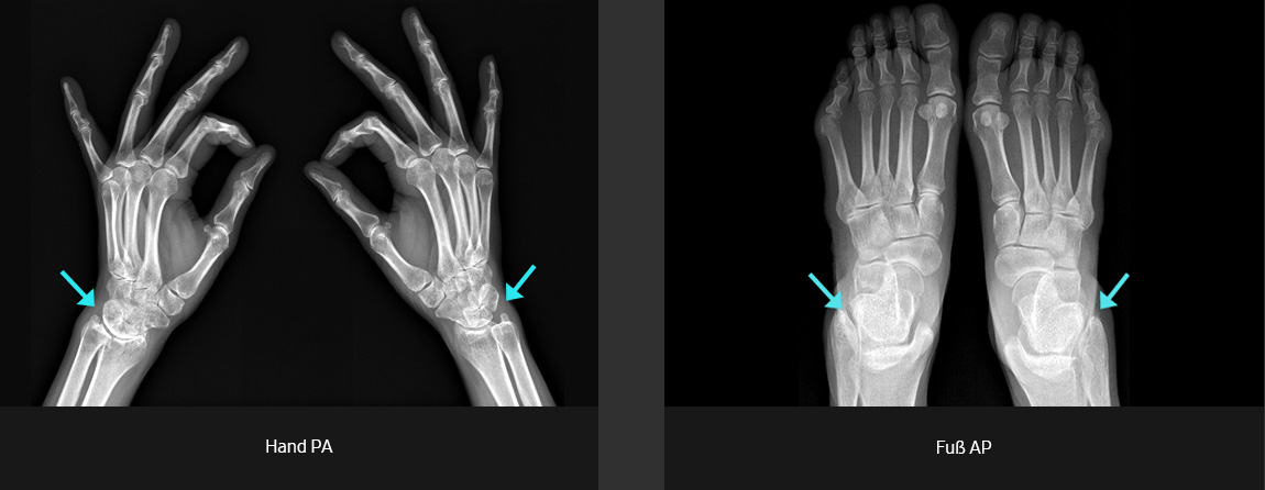Röntgenbilder (überlagerte Fläche, Hand PA, Fuß AP) aufgenommen mit digitalem Röntgengerät von Samsung.