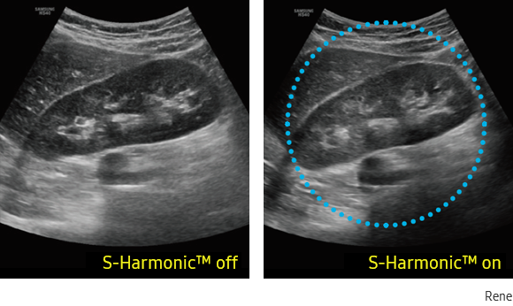 Immagine clinica del rene otenuta con S-Harmonic