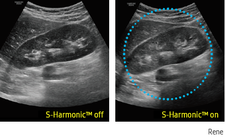 Immagine clinica del rene otenuta con S-Harmonic