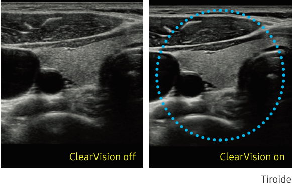 Immagine clinica della tiroide ottenuta con ClearVision