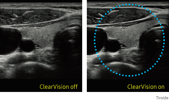 Immagine clinica della tiroide ottenuta con ClearVision
