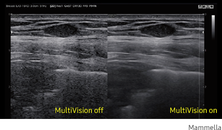 Immagine clinica della mammella ottenuta con software MultiVision