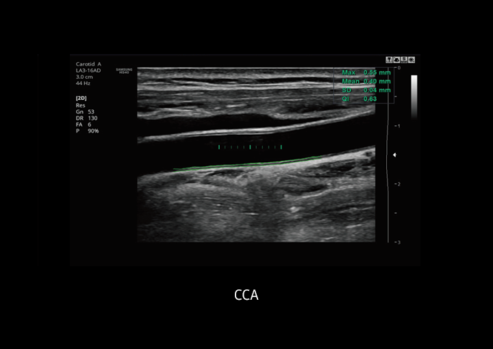Immagine clinica di CCA ottenuta con Auto IMT+
