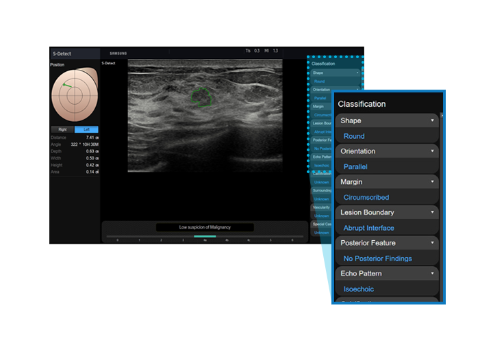 S-Detect™ for Breast