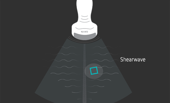 Azione della sonda con S-Shearwave nel tessuto