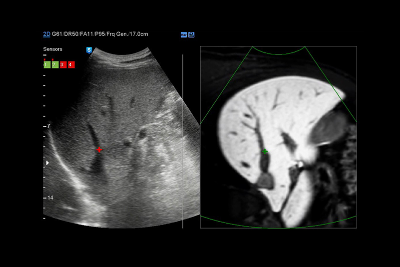 localizzazione simultanea di una lesione con un’ecografia in tempo reale e altre modalità di imaging volumetrico 3D