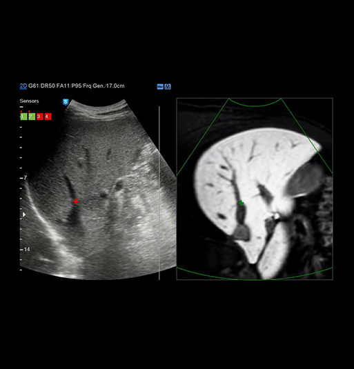  localizzazione simultanea di una lesione con un’ecografia in tempo reale e altre modalità di imaging volumetrico 3D