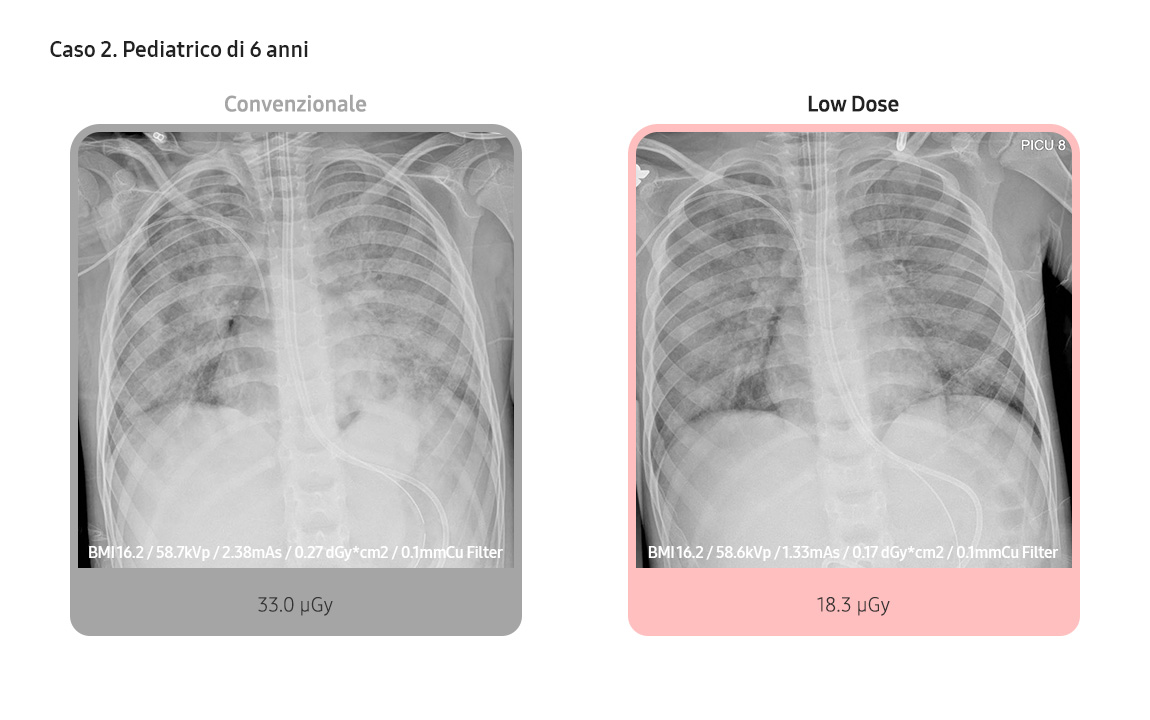 Case 2. Pediatric 6 years
