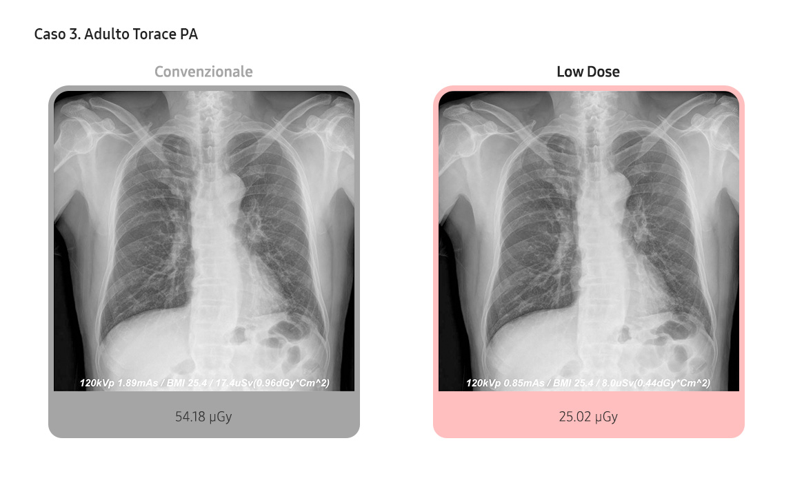 Case 3. Adult Chest PA