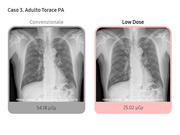 Case 3. Adult Chest PA