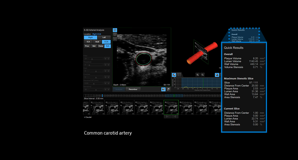 S-3D Arterial Analysis™