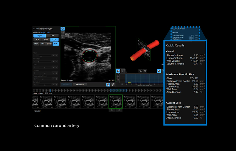 S-3D Arterial Analysis™