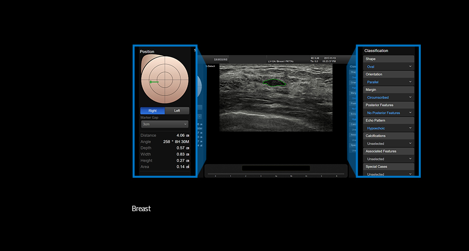 S-Detect™ for Breast