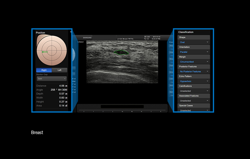 S-Detect™ for Breast