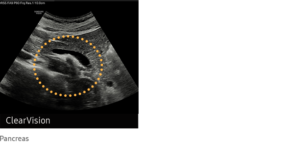 ClearVision Pancreas