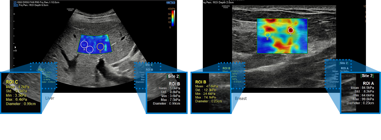 S-Shearwave Imaging™_Breast
