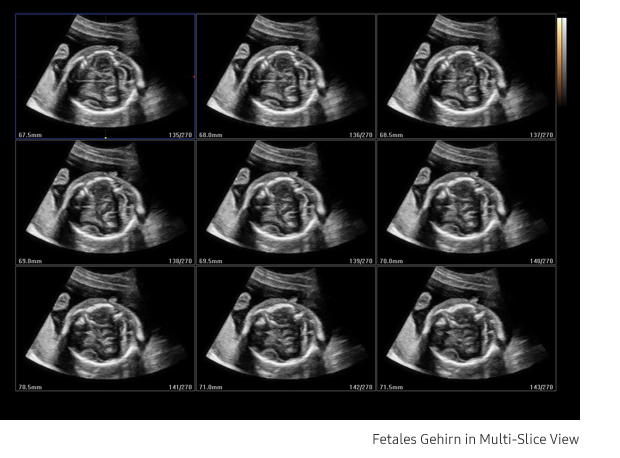 Ultraschallbild fetales Herz aufgenommen mit Ultraschallsystem HS40 von Samsung
