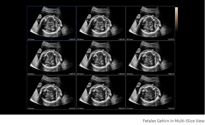 Ultraschallbild fetales Herz aufgenommen mit Ultraschallsystem HS40 von Samsung