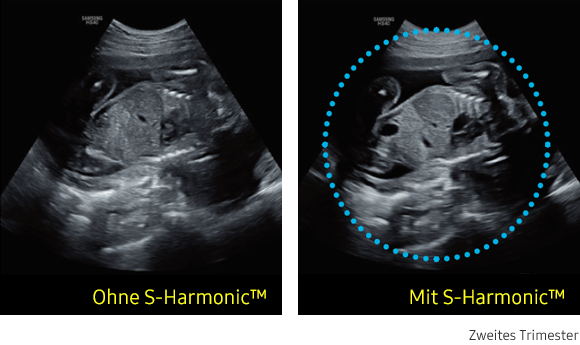 Ultraschallbild links ohne S-Harmonic, rechts mit S-Harmonic