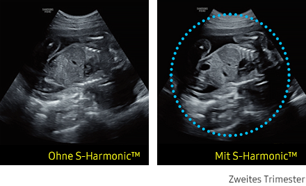 Ultraschallbild links ohne S-Harmonic, rechts mit S-Harmonic