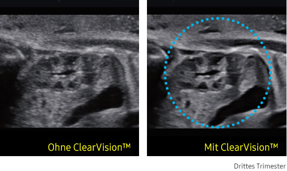 Ultraschallbild links ohne ClearVision, rechts mit ClearVision