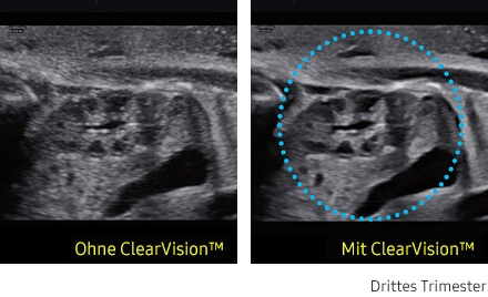 Ultraschallbild links ohne ClearVision, rechts mit ClearVision