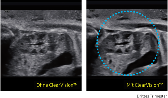 Ultraschallbild links ohne ClearVision, rechts mit ClearVision