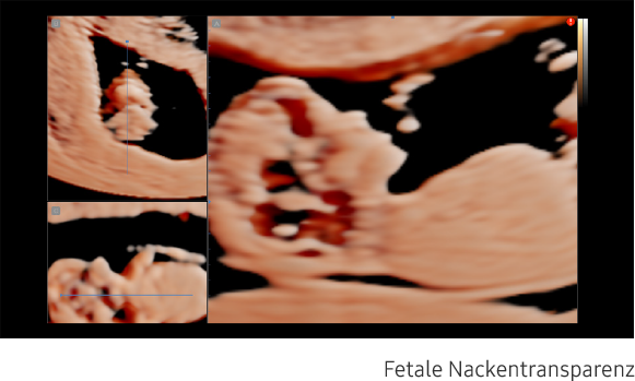 Nuchal translucency