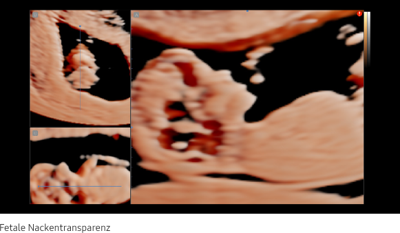 Nuchal translucency